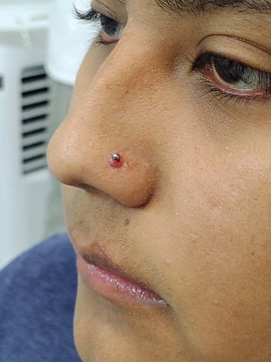 Granuloma en nostril por golpe constante en la zona perforada.